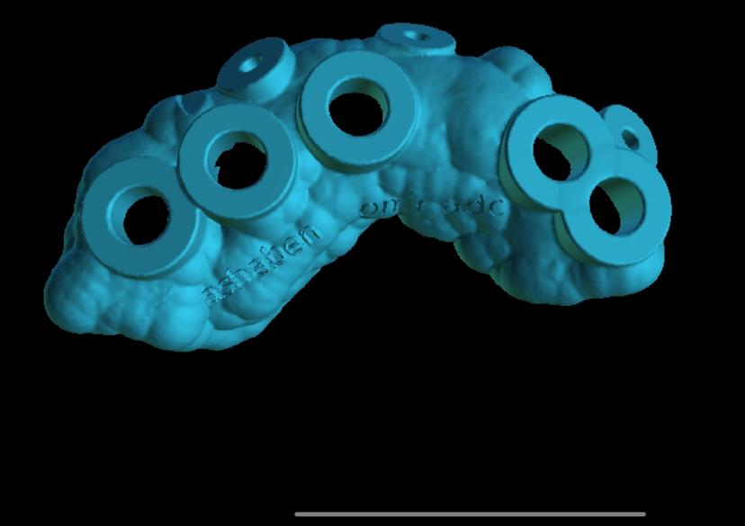 3D printed Surgical Guides