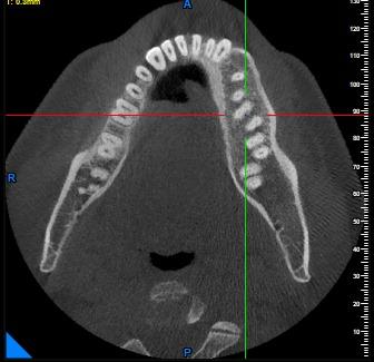 Fibro Osseous Lesions