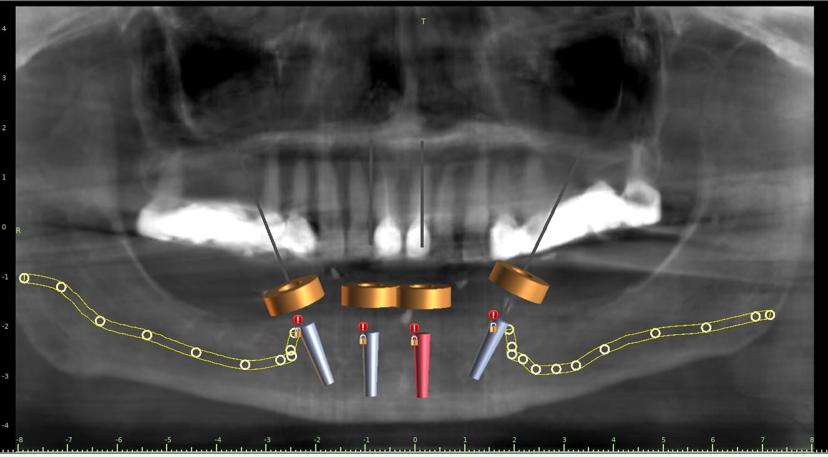 Surgical guide pins placement in patient's mouth