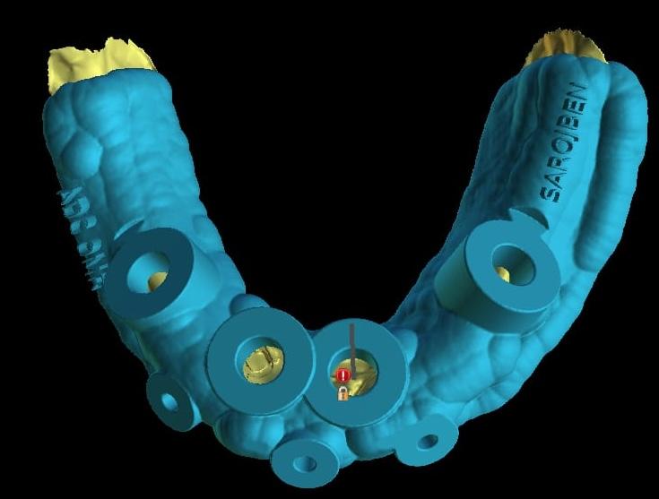 3D rendered surgical guide visualization