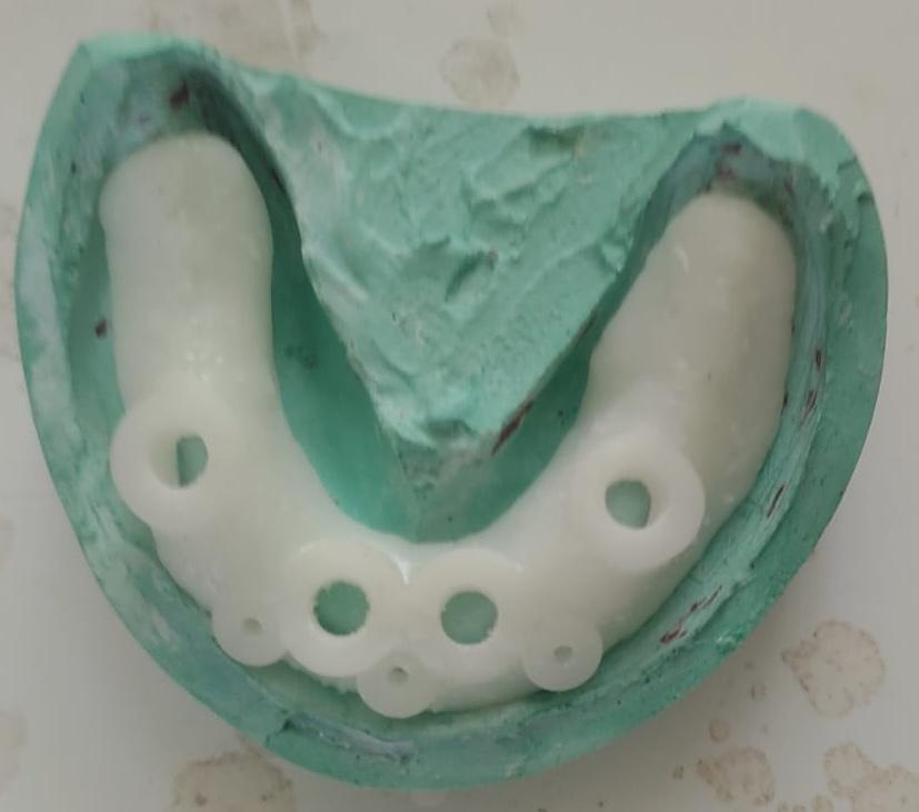 Dental impression model with guide positioning