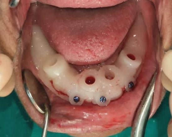 Physical surgical guide with measurements